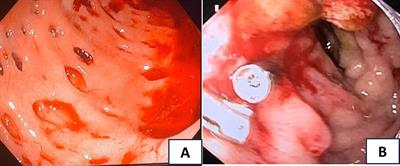 Coinfection of cytomegalovirus and strongyloidiasis presenting as massive gastrointestinal bleeding in an immunocompromised host: a case report